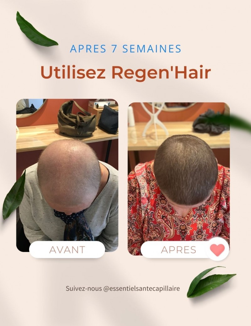 Repousse des cheveux après chimio : avant et après 7 semaines de soin Regen'Hair