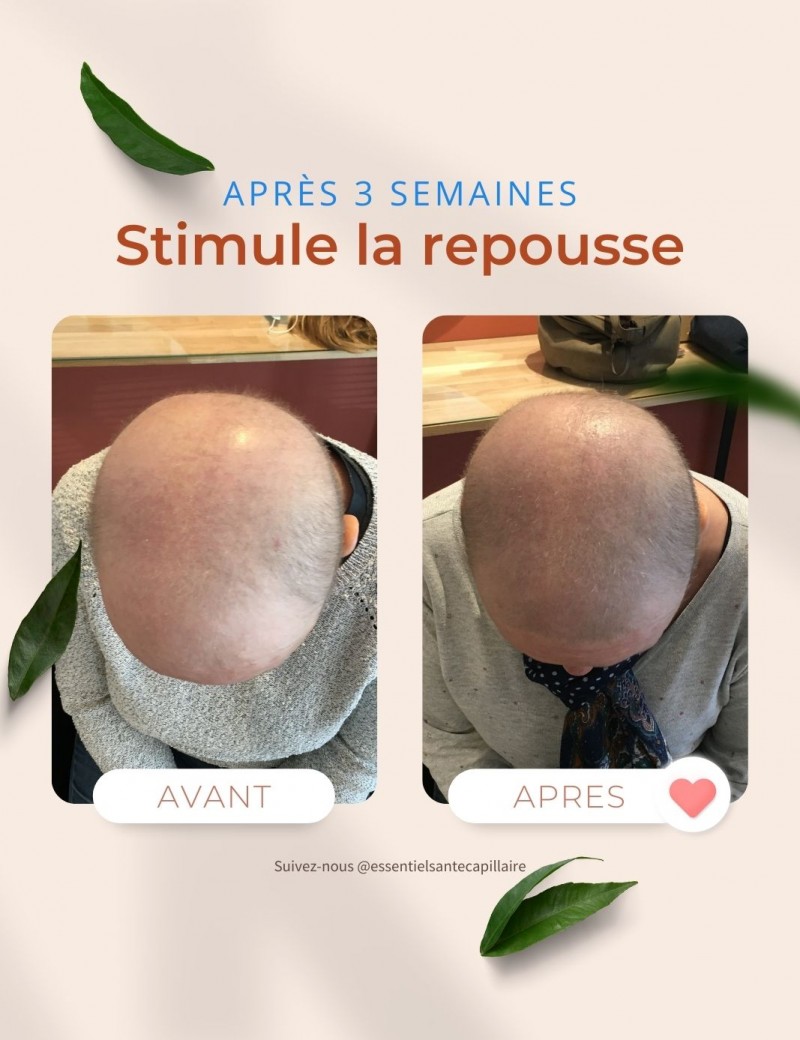 Repousse des cheveux après chimio : avant et après 3 semaines de soin Regen'Hair