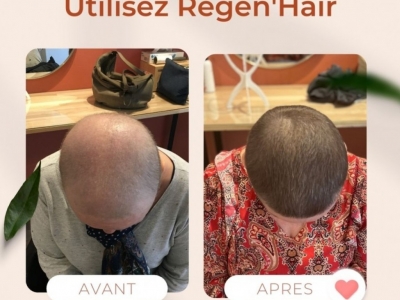 Repousse des cheveux après une chimio, avant et après
